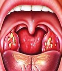 بی‌توجهی به گلودرد چرکی و خطر رماتیسم قلبی