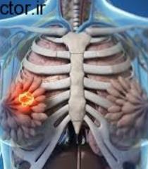 کوچک ترشدن کیست سینه با این روش ها