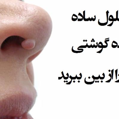 بهترین راه از بین بردن زگیل روی صورت، دست و پا